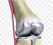 Joint Replacement